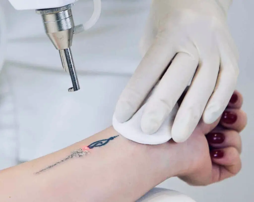 Laserbehandling fjerner tatovering på underarm med professionelt udstyr i klinik.Tattoo Mini